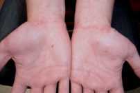 Толстянка: лечебные свойства, польза и противопоказания