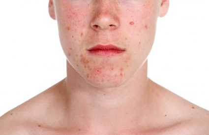 Толстянка: лечебные свойства, польза и противопоказания