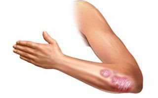 Как вылечить псориаз при помощи магии