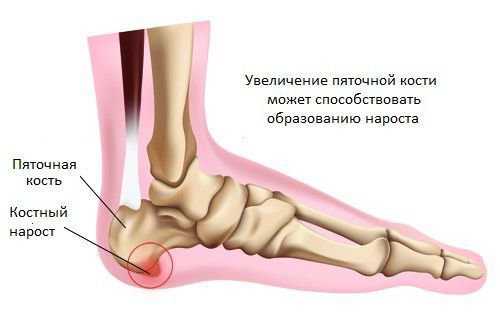 Как заговорить пяточную шпору