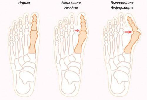 Как заговорить косточку на ноге