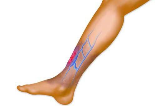 Какие существуют заговоры от варикозного заболевания?