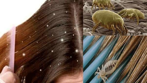 К чему снятся вши в волосах у ребенка по сонникам Миллера, Цветкова, Ванги, Фрейда