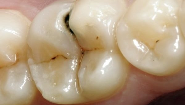 К чему снится дырка в зубе по сонникам Миллера, Цветкова, Фрейда