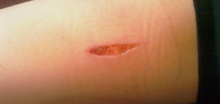 К чему снится гной, нарывы, прыщи, фурункулы по сонникам