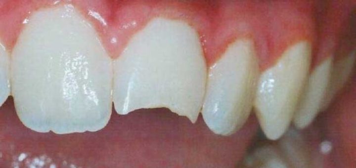 К чему снится, что откололся зуб по сонникам и фактическим значениям