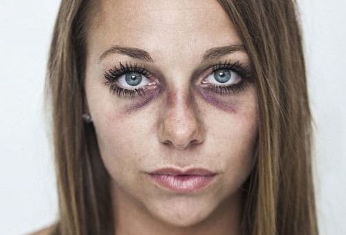 К чему снятся синяки на лице и на теле по основным значениям