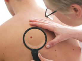 Опасные родинки: удалять или нет