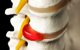 Межпозвоночная грыжа: симптомы, диагностика, разновидности, лечение