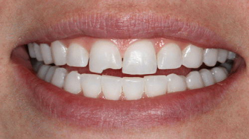 К чему снятся зубы, которые выпадают и крошатся?