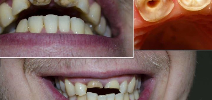 К чему снится гнилой зуб, толкования сонников, психологов и психоаналитиков