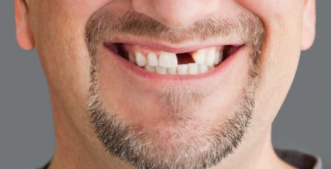 К чему снится выпадение зубов по сонникам Миллера, Лоффа, Цветкова