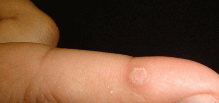 Заговор от бородавок - читать в домашних условиях