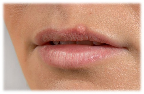 Примета: прыщ на губе - к чему выскакивает прыщик